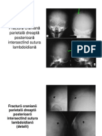 FRACTURi_CRANIANE