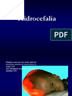 Hidrocefalia