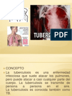 TB: Causas, síntomas y tratamiento de la tuberculosis