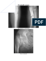 69268612-Fracturile-osoase