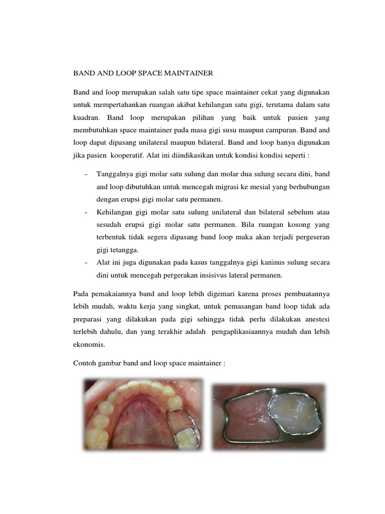 Band and Loop Space Maintainer PDF