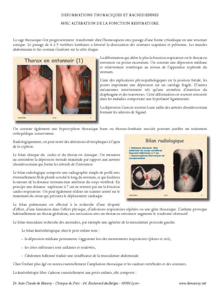 Déformations thoraciques et traitement | PDF | Scoliose | Thorax