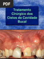 Tratamento Cirúrgico dos cistos