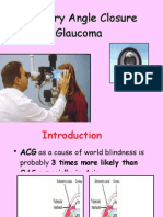 Primary Angle Closure Glaucoma for UGs