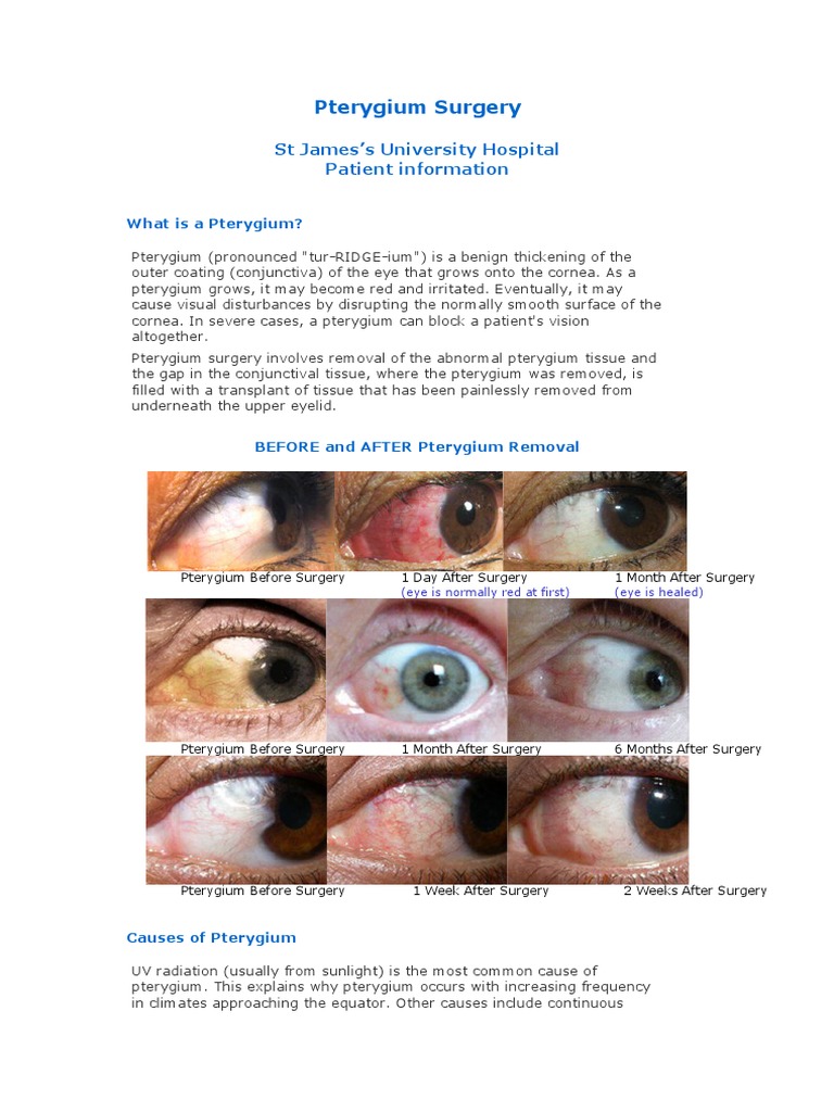 Thesis on pterygium 06 picture