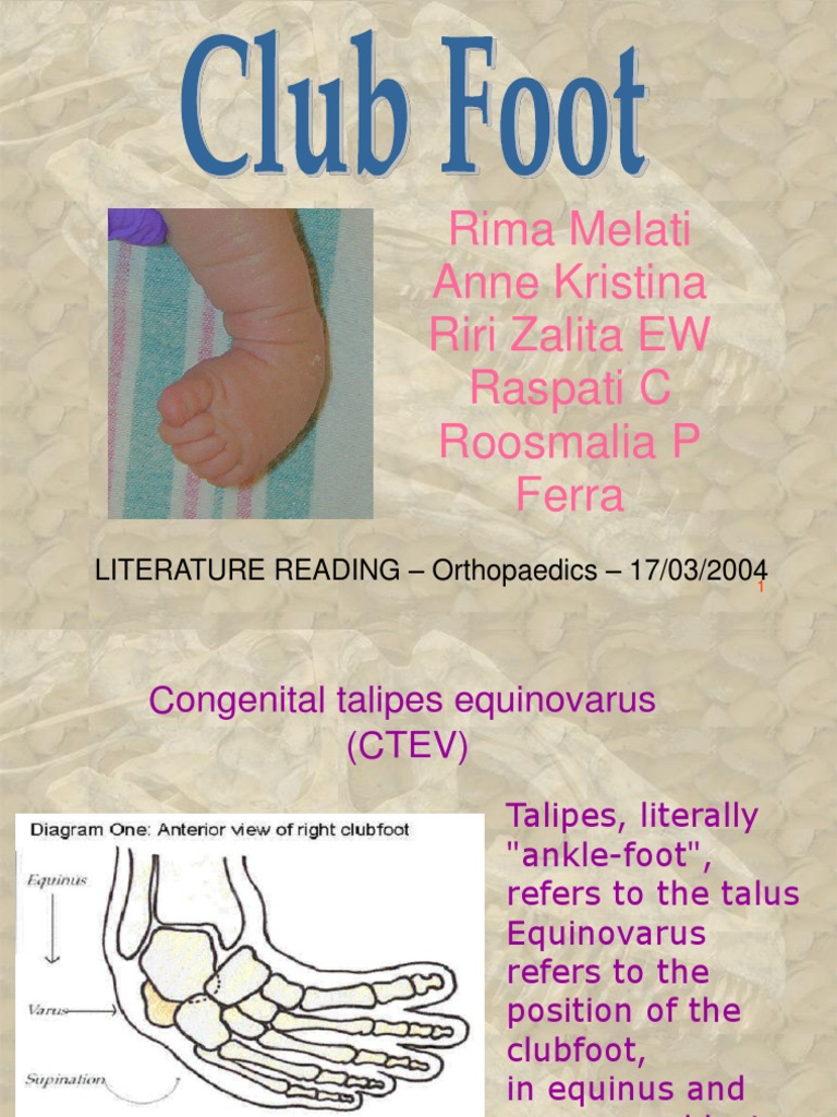 Club Foot Foot Orthopedic Surgery