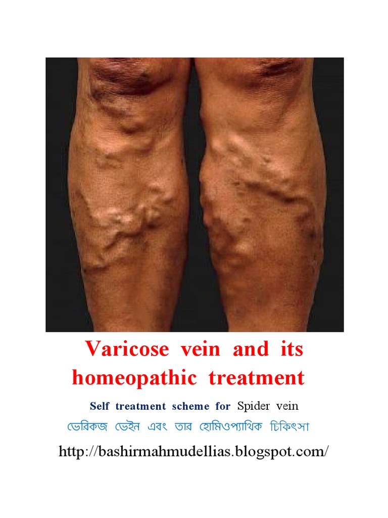 Varicose Vein and Its Homeopathic Cure _ Dr Bashir Mahmud Ellias