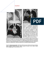 A Primera Vista 412 (Secuestro Pulmonar)