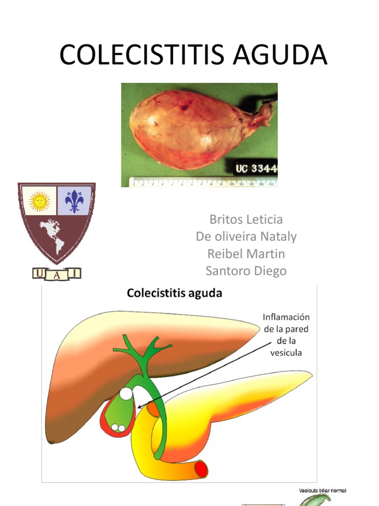 Sintomas De Colecistitis