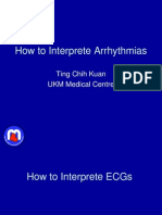 How To Intepret Arrythmias