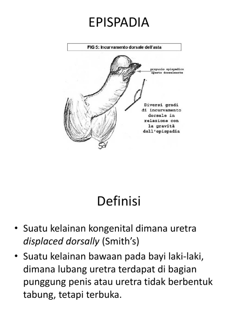 EPISPADIA | PDF