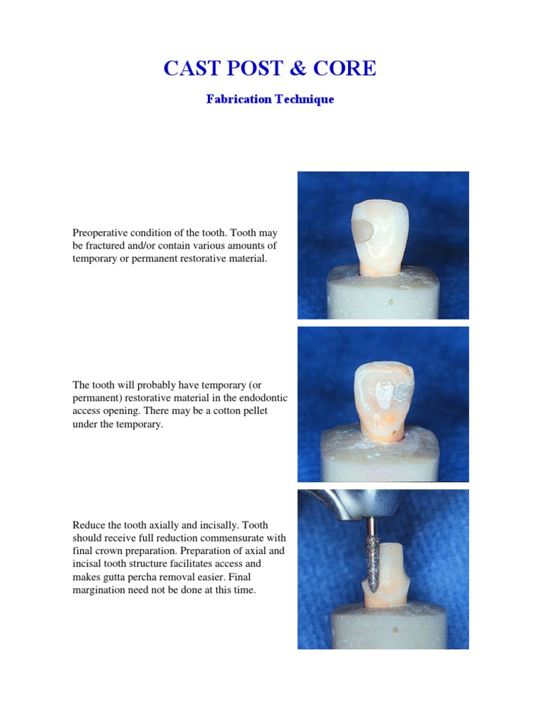 Post and Core Fabrication PDF Dentistry Branches Dentistry