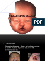 Fisuras de Labio y Paladar