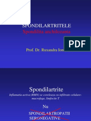 Spondilita: Ce este? Tipuri si Simptome & Cauze