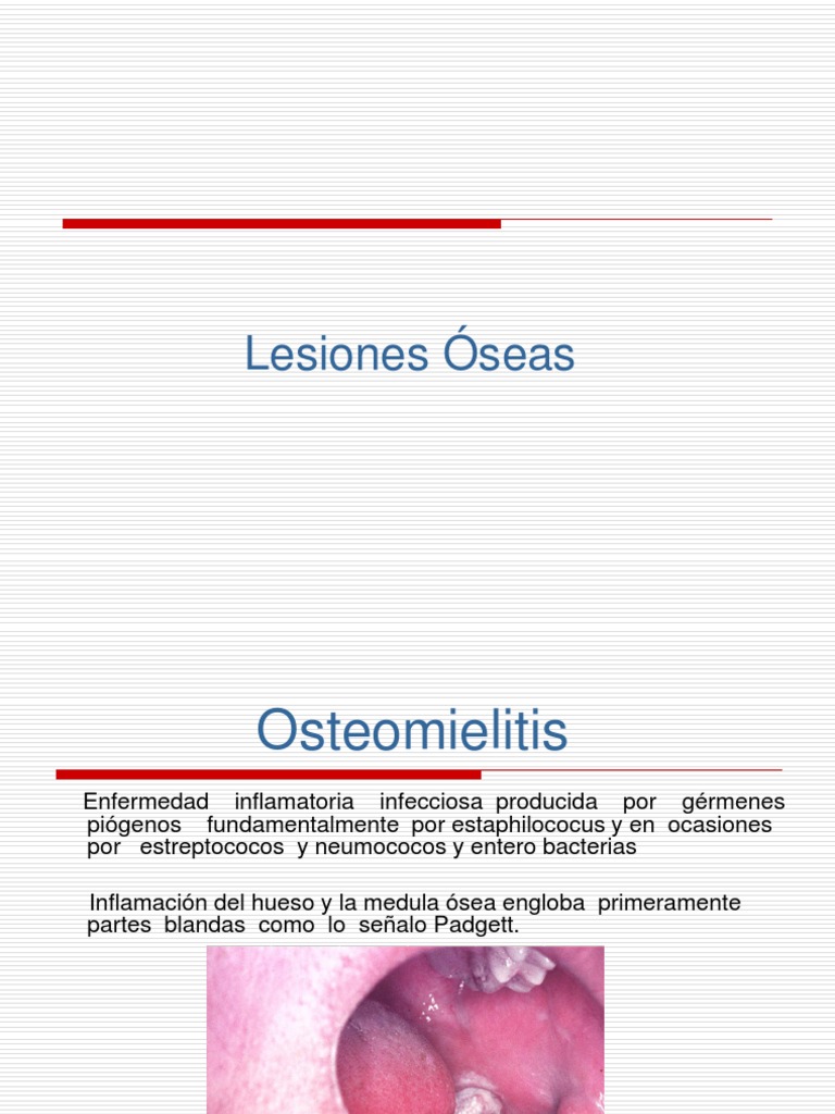 Osteítis | PDF | Hueso | Inflamación