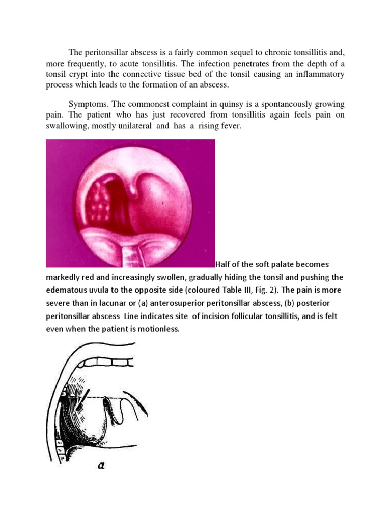 The Peritonsillar Abscess Is A Fairly Common Sequel To Chronic ...