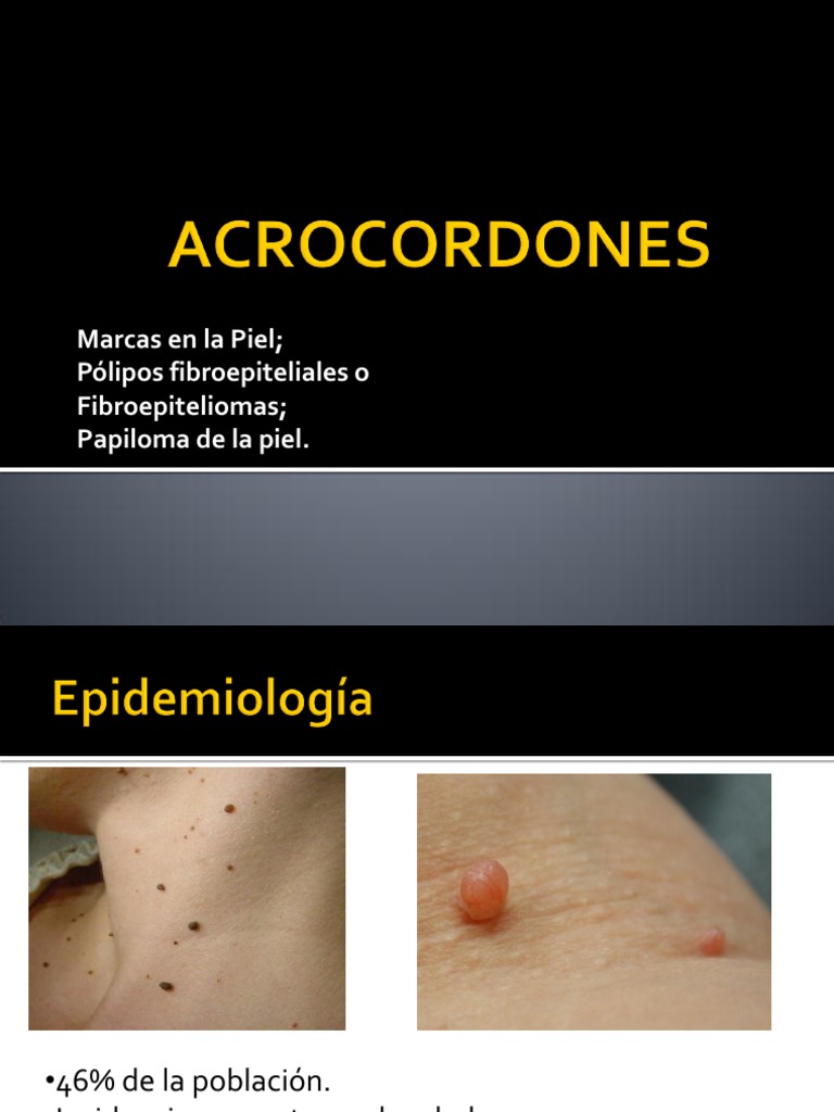 ACROCORDONES | PDF