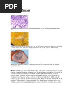 Download Breast Cancer by james garcia SN20300417 doc pdf