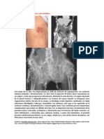 A Primera Vista 431 (Calcinosis Cutis Distrófica)