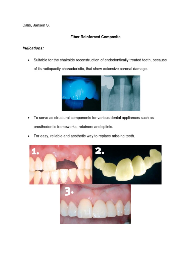 Fiber Reinforced Composite PDF Human Tooth Dental Implant