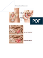 Adenocarcinomul de Prostata