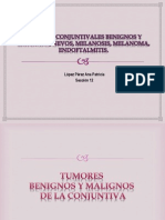 Tumores Conjuntivales Benignos y Malignos, Nevos