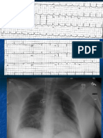 4.4.07 Vidwan Myocarditis