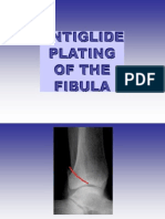 Aniglide Plating of The Fibula.
