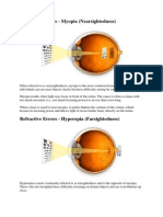 Refractive Errors - Myopia (Nearsightedness)
