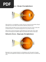 Refractive Errors - Myopia (Nearsightedness)