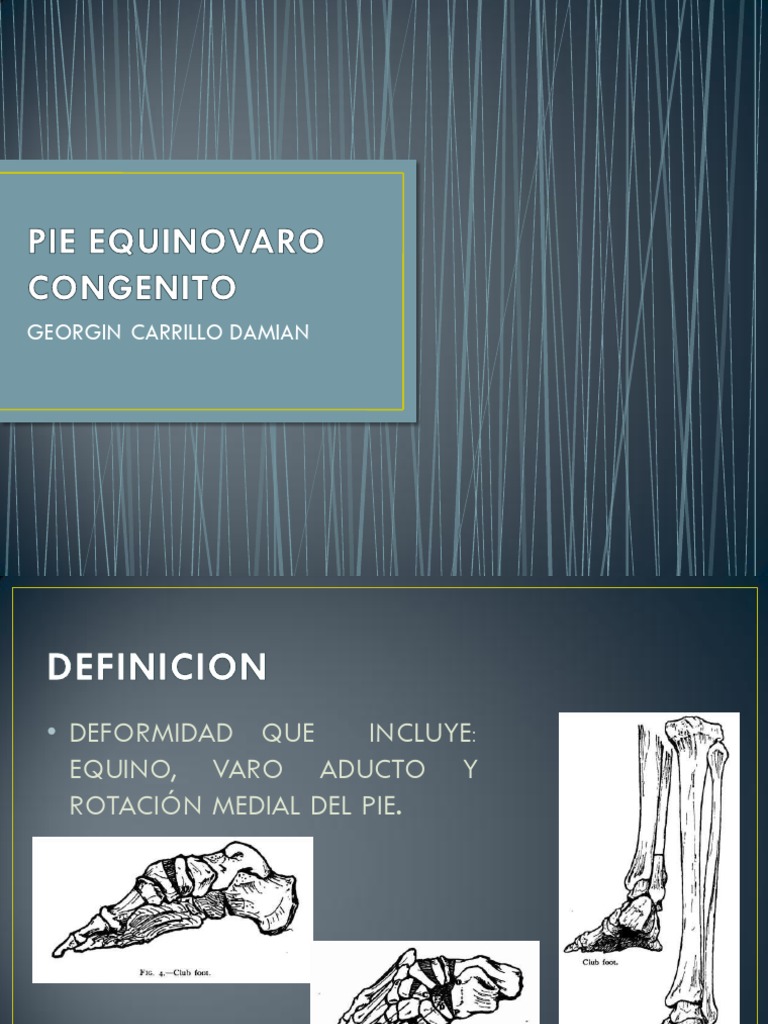 Pie Equinovaro Congenito PDF