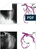 Angiography Coroner