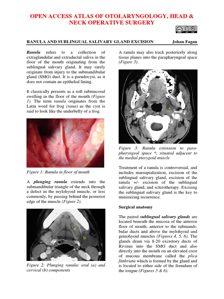 Ranula and Sublingual Salivary Gland Excision | PDF