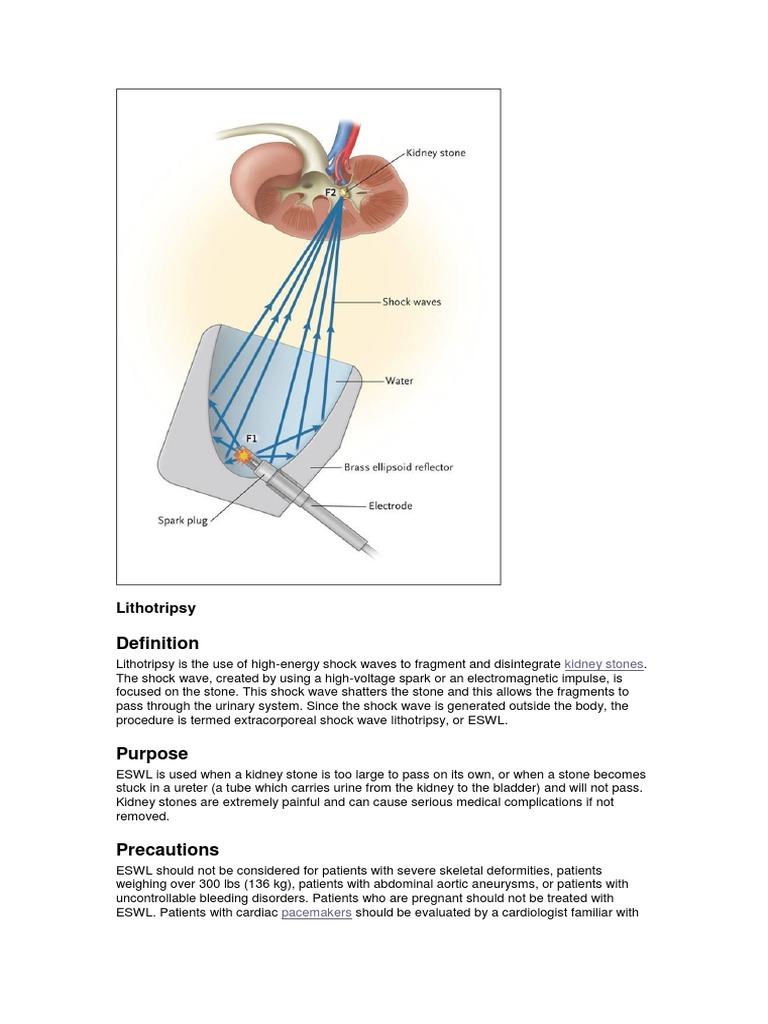 Lithotripsy Surgery Health Sciences