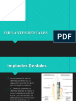 Tipos de Implante