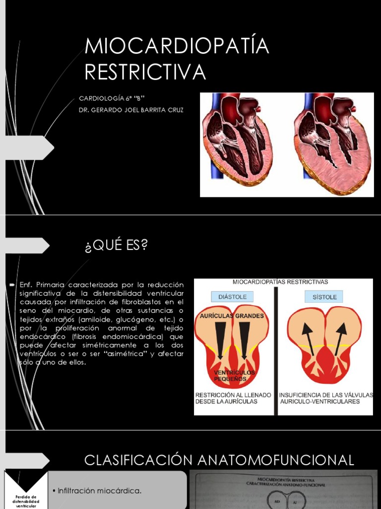 Miocardiopatía Restrictiva Completa | PDF | Cardiología | Medicina CLINICA