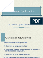 Carcinoma Epidermoide