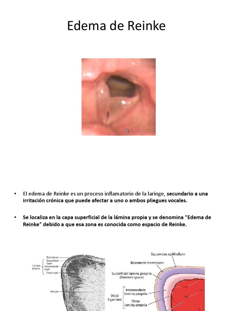 Edema de Reinke TEXTO PDF Tos Enfermedades y trastornos
