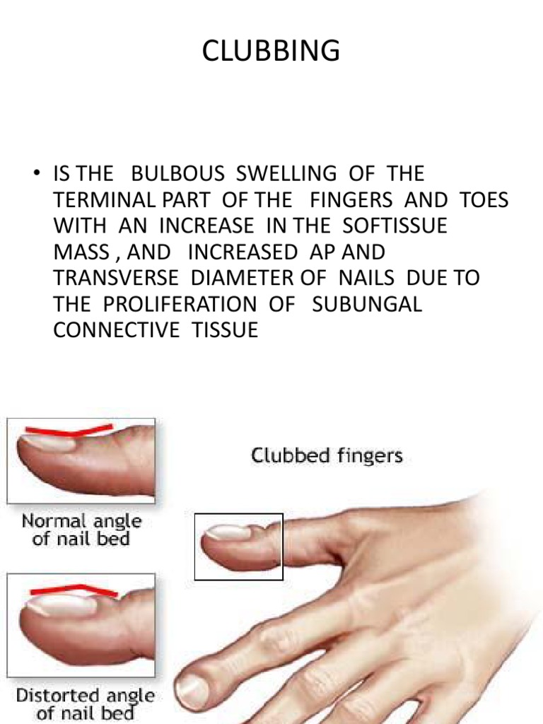 Clubbing Lung Medical Specialties