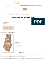 Eliminación del juanete parte 4- MedlinePlus