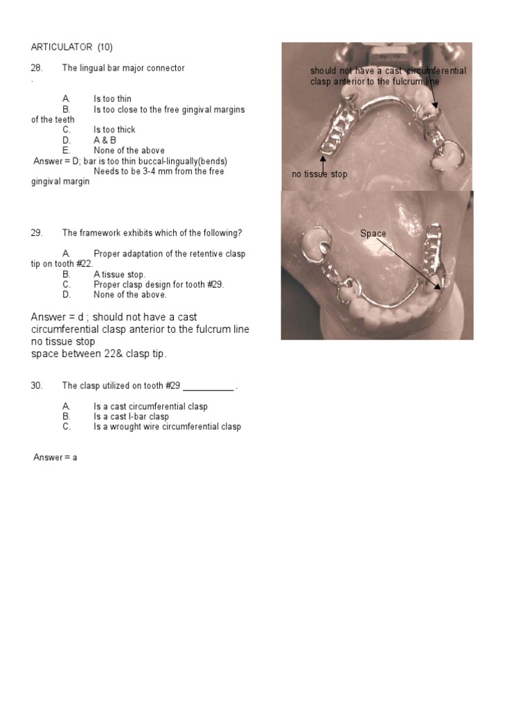 RPD Design: Lingual Bar & Tissue Stops | PDF | Dentures | Dental Anatomy