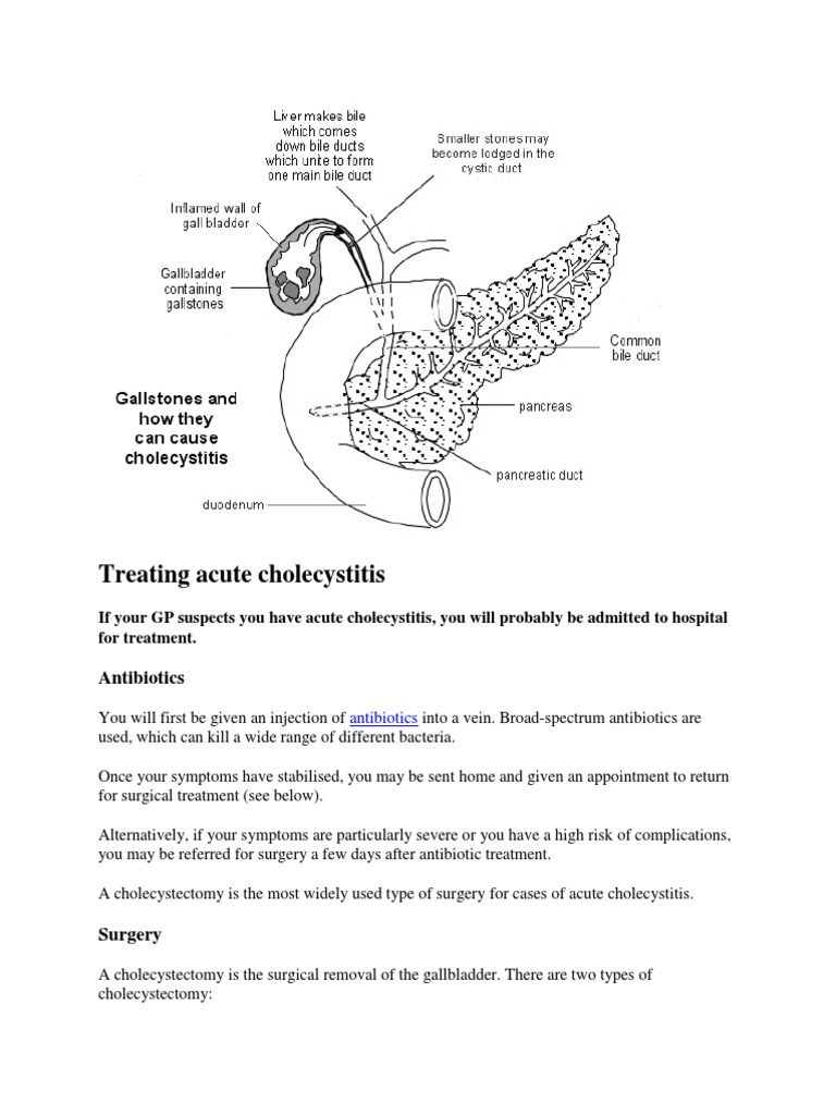 Treating Acute Cholecystitis PDF Gallbladder Digestive System