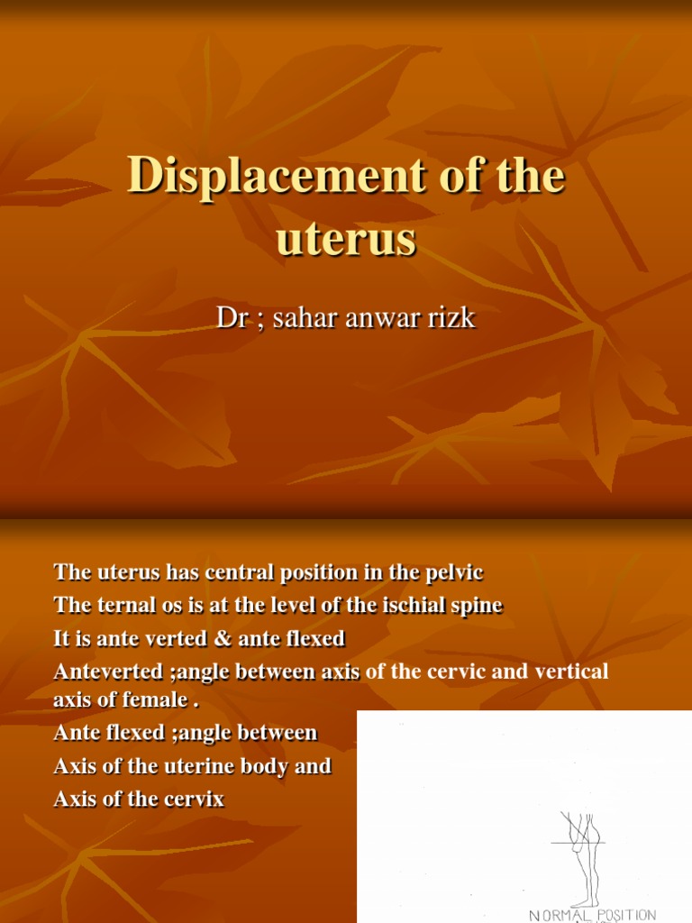 Displacement of The Uterus DR Sahar Anwar Rizk PDF Uterus Vagina