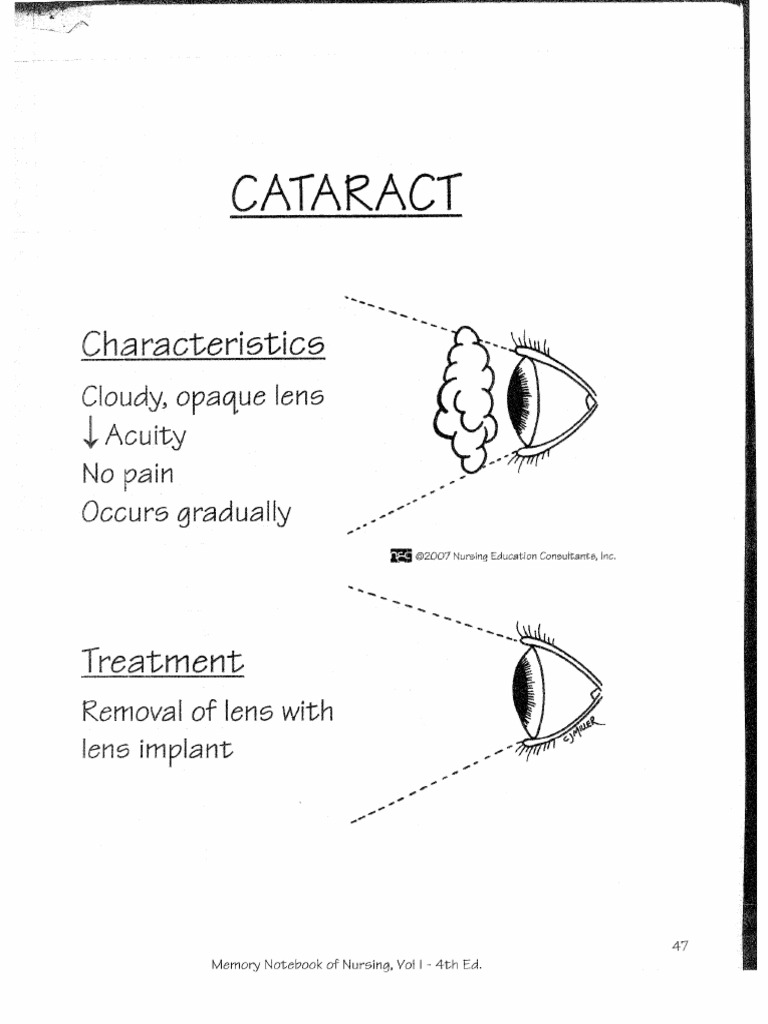 Cataract
