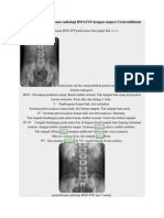 BNO IVP Ureterolithiasis