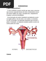 Endometriose-1