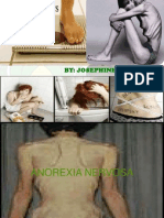 Anorexia Nervosa