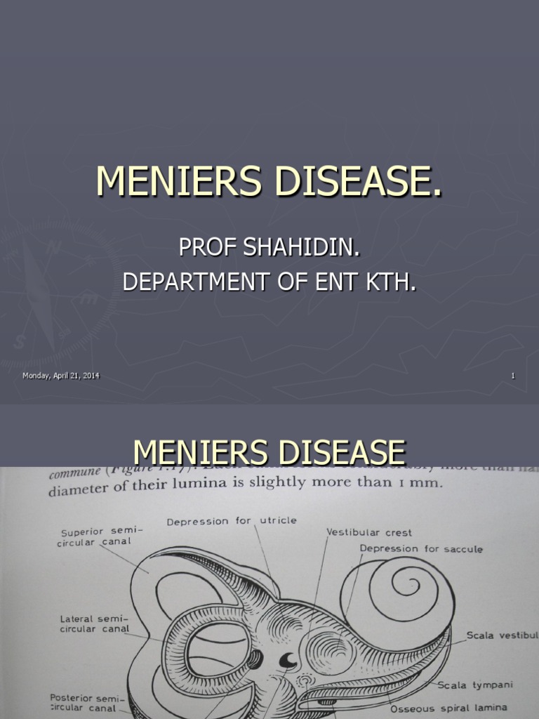 Meniers Disease Vertigo Ménière's Disease