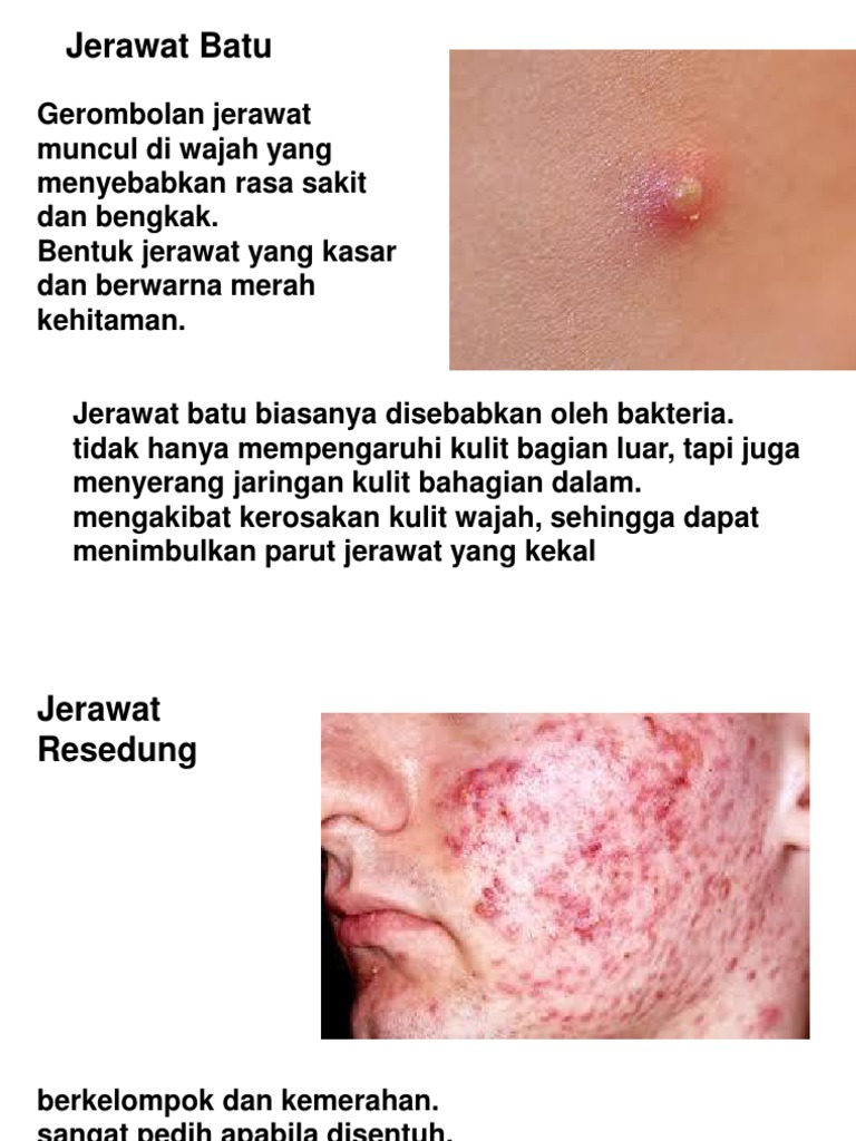 Jerawat Pdf
