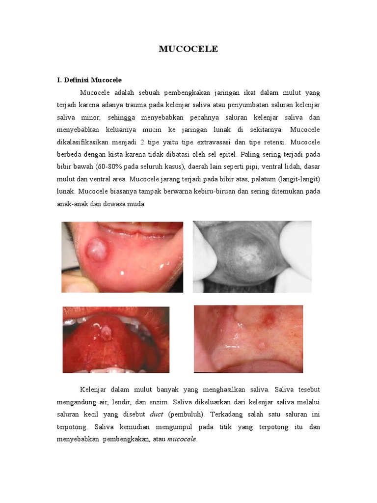 Penanganan dan Diagnosa Mucocele | PDF
